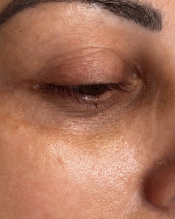Pele após tratamento de melasma na NURA